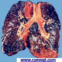 Este é o meu pulmão e de todos os outros fumantes